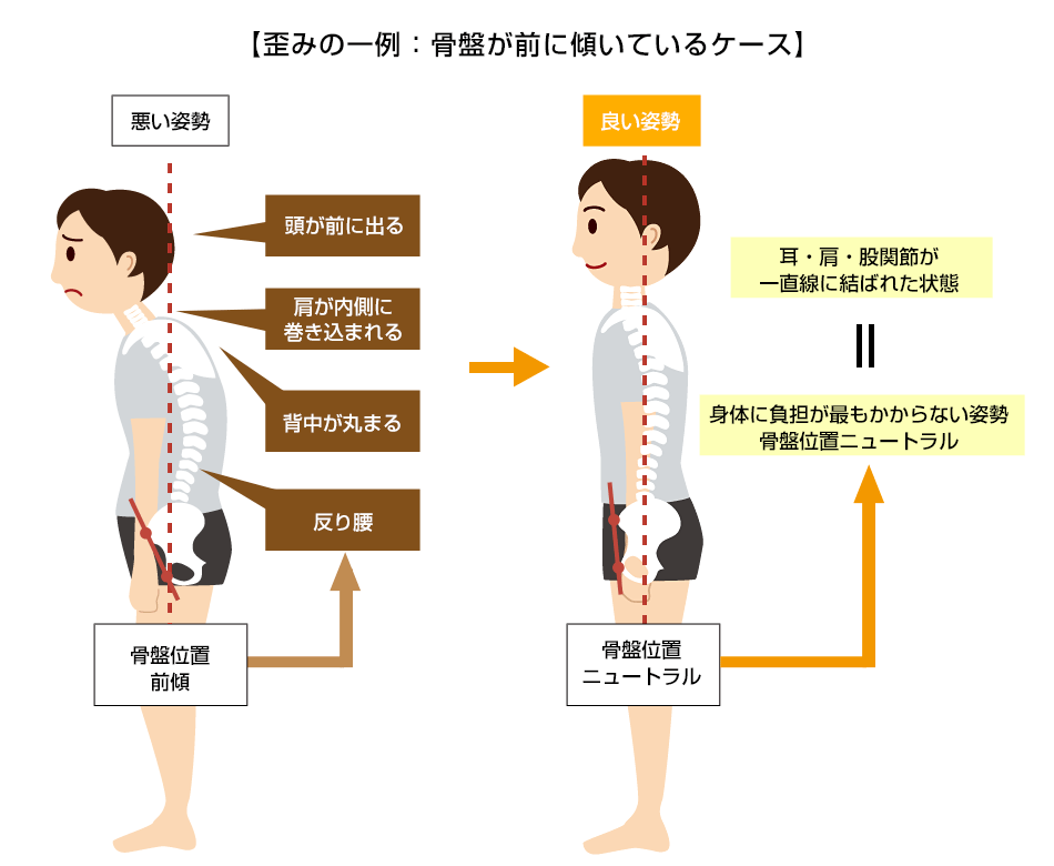 歪みの一例：骨盤が前に傾いているケース