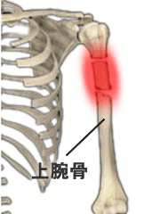 二の腕の痛みの治療 京王線桜上水 うえた鍼灸整骨院 はれやか整骨院